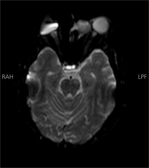 Brain MRI DWI sequence showing abnormal hyper-intense signal (bright) in the distribution of the left cavernous sinus. The left ethmoidal sinus synovial tumor is also noted.