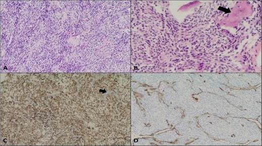 Synovial sarcoma, monophasic. (A) Moderately cellular neoplasm composed of monotonous oval to spindle-shaped cells (Hematoxylin and eosin stain, 10×); (B) Foci of bone trabeculae entrapment noted (arrow) (20×); (C) Positive TLE1 immunostaining (nuclear brown staining); negative internal control in endothelial cells (arrow) (10×); (D) Negative CD34 immunostaining in the neoplastic cells (highlight endothelial cells only). The tumor cells were negative for CKAE 1/3, EMA, CK7, CK19, S-100, Myogenin, SMA, Progesterone receptor, STAT6, and Beta-catenin.