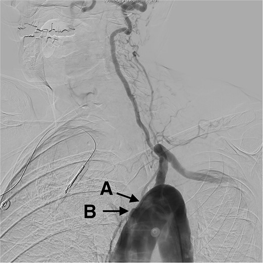 Digital subtraction angiogram demonstrating: (A) occlusion in the origin of the left common carotid artery. (B) Occlusion at the origin of the brachycephalic trunk artery.