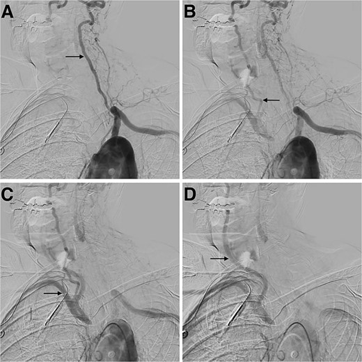 Digital subtraction angiogram demonstrating: (A) anterograde flow in the left vertebral artery and contrast going through the basilar formation. (B) Retrograde flow in the right vertebral artery. (C) Contrast reaching the right subclavian artery. (D) Anterograde flow in the right common carotid artery.