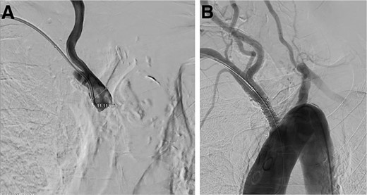 Digital subtraction angiogram demonstrating: (A) brachiocephalic artery occluded before the stent placement. (B) Brachiocephalic artery opened after the introduction of the Gore Viabahn VBX Balloon Expandable Stent (W.L. Gore & Associates, Flagstaff, AZ, USA).
