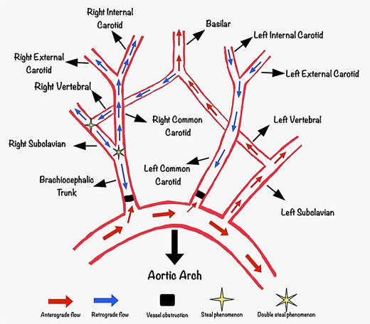 Diagram demonstrating the blood flow of the patient. Anterogradely the left vertebral artery fills the basilar artery and retrogradely fills the right subclavian artery and the common carotid artery through the right vertebral artery, resulting in a double steal phenomenon. The left internal carotid artery is filling from the left occipital artery in a retrograde flow fashion.