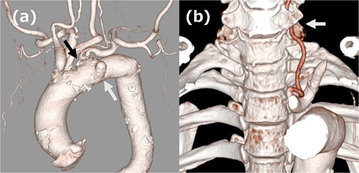 (a) Three-dimensional computed tomography (3DCT) image. The white arrow indicates the aortic aneurysm, and the black arrow indicates ILVA. (b) 3DCT image. The white arrow indicates the entry of ILVA under the transverse process of the vertebra at the sixth cervical vertebra.