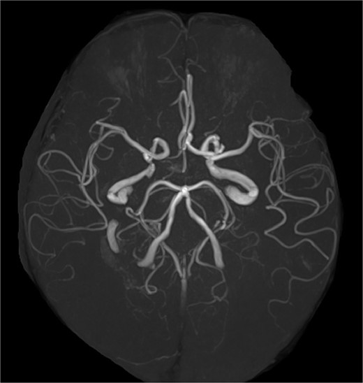 Magnetic resonance angiography image. The Willis arterial circle is incomplete.