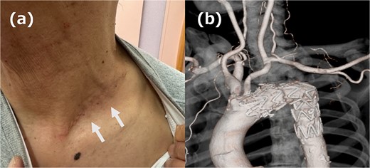 (a) Picture of the wound. The white arrow indicates the wound. (b) 3DCT image. All reconstruction was performed without artificial vessels.