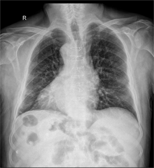 Chest X-ray showing dextrocardia.