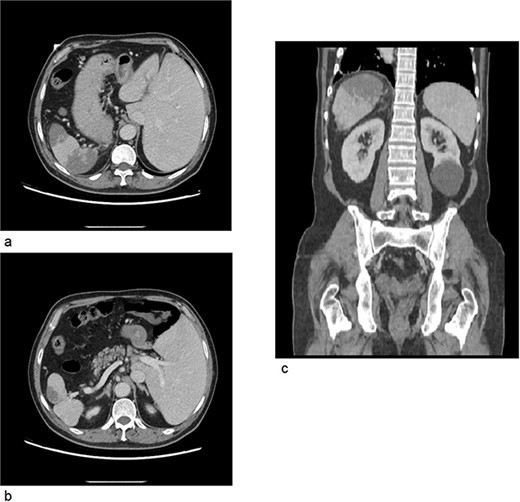 (a) CT axial cross section showing the liver on the left side of the abdomen and the spleen on right side with multiple splenic infarcts. (b) CT axial cross section showing patent splenic vein. (c) CT coronal cross section showing splenic infarcts as well as a left kidney cyst.