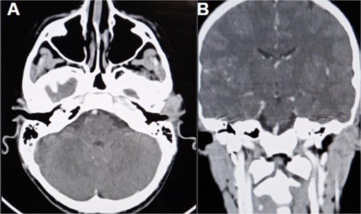 CT scan (A) axial section shows an ill-defined subcutaneous granulomatous process. (B) Coronal section of the process causing scalloping of the temporal bone.