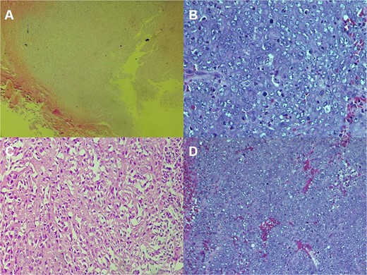 Histologic staining photomicrographs show multinodular architecture with central areas of necrosis (A; H-E stain; original magnification, ×40). Tumor cells are polygonal with eosinophilic cytoplasm, vesicular chromatin, and conspicuous nucleoli (B; H-E stain; original magnification, ×100). Areas of spindle-shaped cells (C; H-E stain; original magnification, ×200). Mitoses were noted (D; H-E stain; original magnification, ×400).