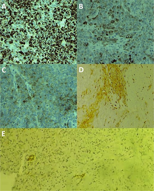 Immunohistochemical staining photomicrographs show cytoplasmic expression of cytokeratin AE1/AE3 (A; cytokeratin; original magnification, ×400), cytoplasmic expression of CK19 (B; CK19; original magnification, ×400), cytoplasmic expression of EMA (C; EMA; original magnification, ×400), focal membranous expression of CD34 (D; CD34; original magnification, ×200), and focal nuclear expression of ERG (E; ERG; original magnification, ×200).