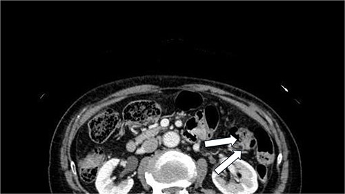 Abdominal contrast-enhanced CT showed the herniation of the retroperitoneal fat tissue into the abdominal wall was observed dorsally to the left kidney(arrow).