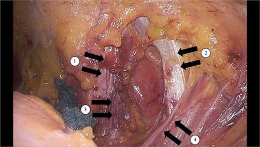 A 3 cm × 2 cm hernia orifice, bordered by the ①12th rib lower edge, ②internal oblique muscle, ③serratus posterior inferior muscle, and ④quadratus lumborum muscle, was identified.