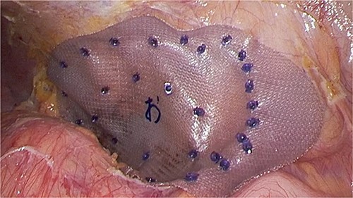 A BARD Ventralight ST 10.2 × 15.2 cm mesh was placed, and it was fixed to the ribs and muscles using the double crown method with AbsorbaTack.