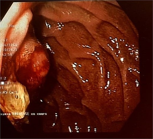 Endoscopic view.