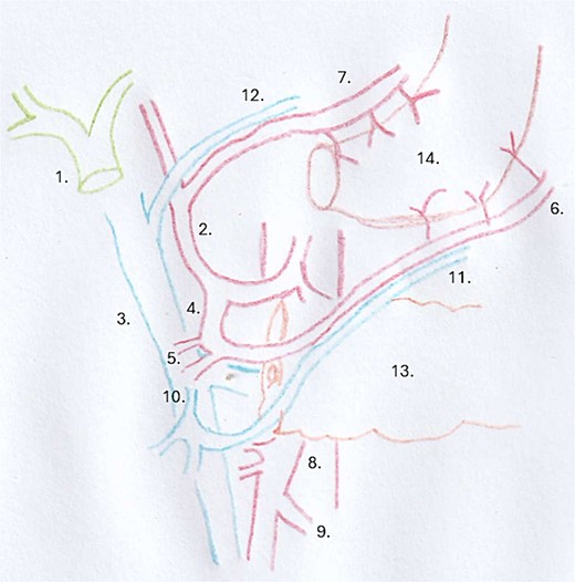 Surgical drawing: 1 = common hepatic duct, 2 = proper hepatic artery, 3 = portal vein, 4 = gastroduodenal artery, 5 = superior pancreaticoduodenal artery, 6 = right gastroepiploic artery, 7 = right gastric artery, 8 = superior mesenteric artery, 9 = middle colic artery, 10 = gastrocolic trunk of Henlé, 11 = right gastroepiploic vein, 12 = right gastric vein, 13 = pancreas, 14 = gastric plasty.