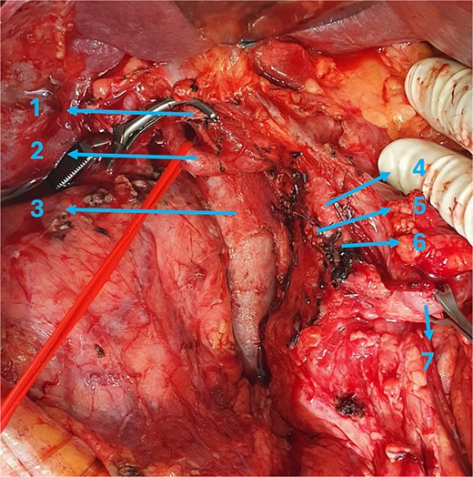 Intraoperative view: 1 = common hepatic duct, 2 = proper hepatic artery, 3 = portal vein, 4 = gastroduodenal artery, 5 = superior pancreaticoduodenal artery, 6 = right gastroepiploic artery, 7 = pyloric section.