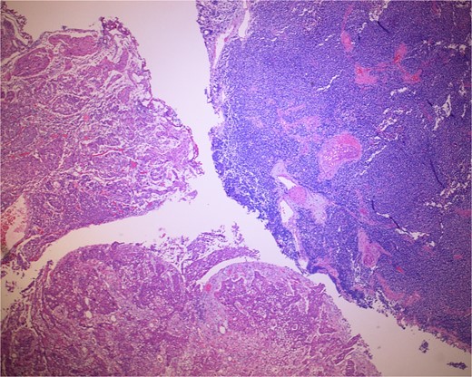 Low-power view of the neoplasm shows urothelial carcinoma on the left and neuroendocrine carcinoma on the right of the image.