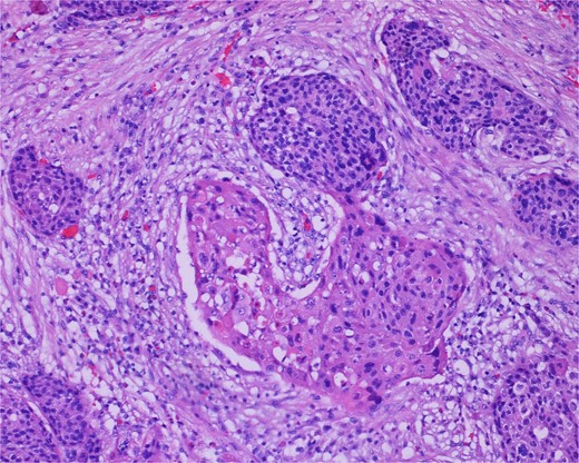 High-power view of the neoplasm shows focal merging of the high-grade neoplasm with squamoid differentiation.