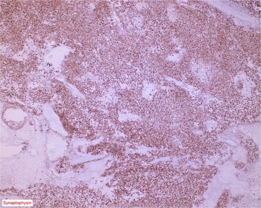 Immunostain for synaptophysin is conspicuously and diffusely positive in the neuroendocrine component of the neoplasm.