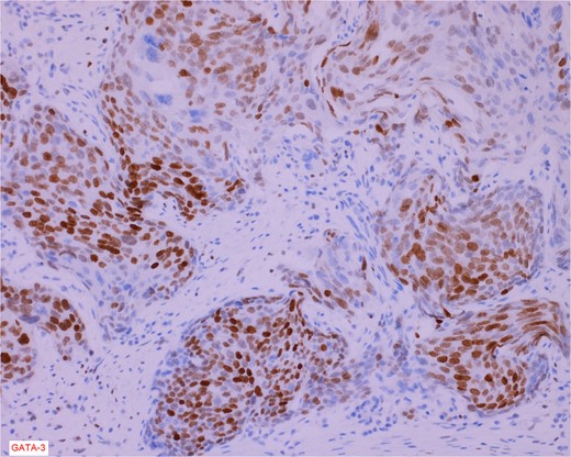 Immunostain for GATA-3 is conspicuously positive in the high grade urothelial carcinoma component.