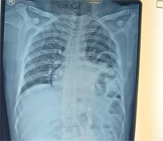 Chest X-ray PA view showing the herniation of bowel loops into the left hemithorax with collapse of the lower zone of the lung.