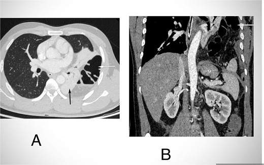 CECT abdomen and lower chest in axial section in lung window (A) and coronal section (B) shows herniation of transverse colon and its mesocolon (white arrow) through a defect in left hemidiaphragm into the hemithorax. There is passive atelectasis of the lower lobe of the left lung (black arrow in A).