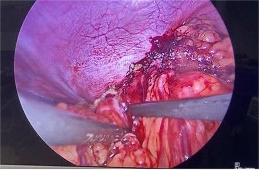 Intraoperative picture showing the defect in the left diaphragm with the omentum and bowel loops as content.