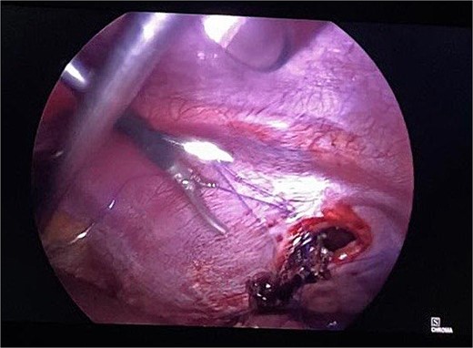 Intraoperative picture following reduction of hernia. The defect is being closed with prolene.