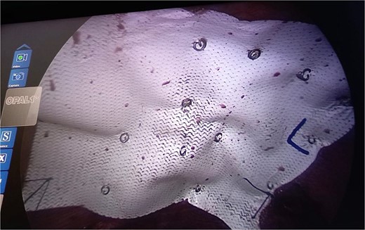 Intraoperative picture showing composite mesh placement over the defect.