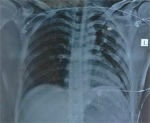 Post-operative picture with no evidence of herniation of bowel content to the left hemidiaphragm.
