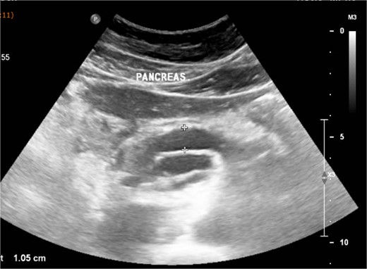 Abdominal ultrasound shows a diffuse dilation of the main pancreatic duct.