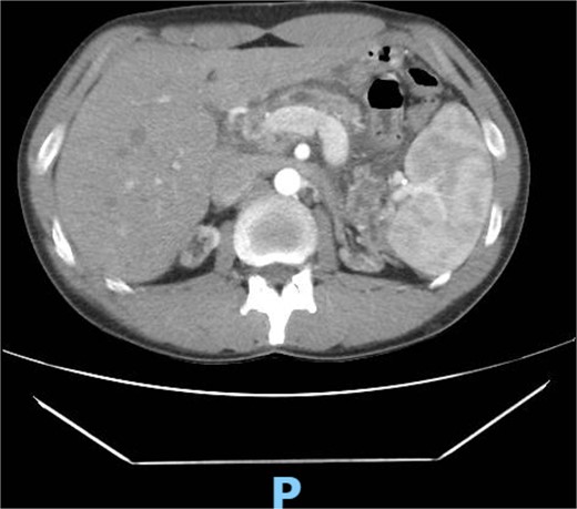 Abdominal computed tomography shows a diffuse dilation of the main pancreatic duct and Santorini duct, as well as dilation of secondary ducts. There are stones in the main pancreatic duct in the head region. Also, there is a reduction in the thickness of the pancreatic parenchyma, associated with small intervening calcifications, possibly due to chronic pancreatitis.