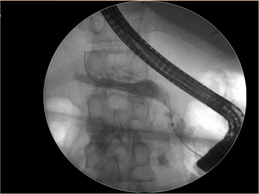 Endoscopic retrograde pancreatography shows an unsuccessfully cannulated pancreatic duct.