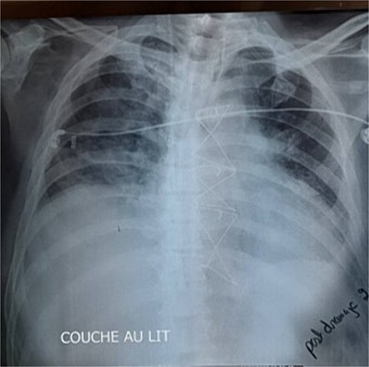 The chest X-ray showed right pulmonary edema, with total deviation of the heart to the left, as well as an elongation and straightening of the left heart border.