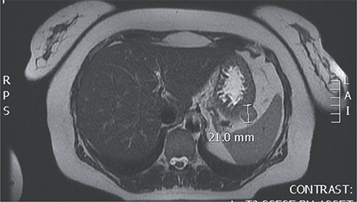 Magnetic resonance of GIST at the posterior of the fundus of the stomach.