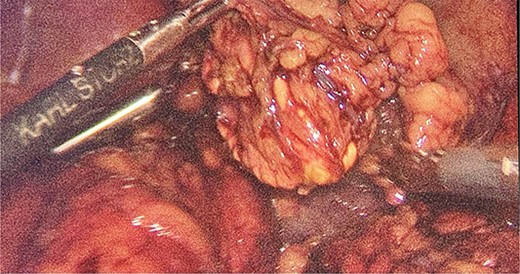 Intraoperative finding of the left suprarenal gland.