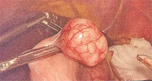 Intraoperative view of GIST.