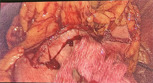 Intraoperative view of the stomache after wedge resection.