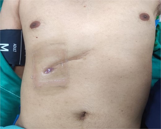 Showing Sinus opening at previous operated site over right subcostal region.
