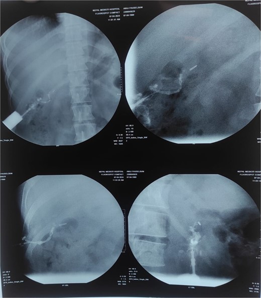 Sinogram showing blind ending tract extending from sinus opening upto the surgical clips in GB fossa probably biliarycutaneous fistula.