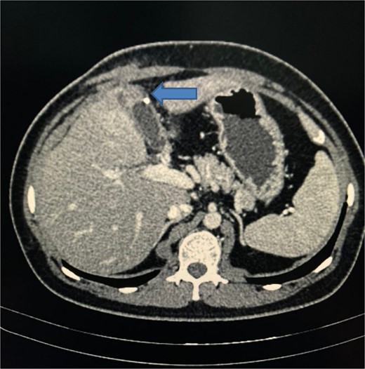 CT scan of abdomen showing a walled-off fluid collection with a small calcific density and a soft tissue density tract-like lesion extended from the anterior aspect of the collection towards the subcutaneous plane of the right upper abdominal wall, suggesting a sinus tract.