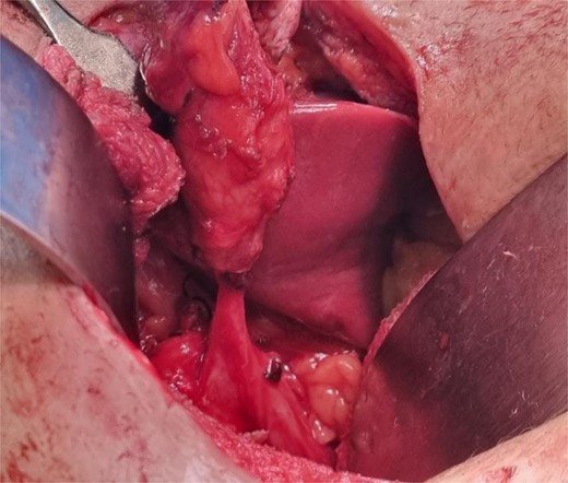 Intraoperative image showing cystocutaneous fistula tract with remnant gall bladder.