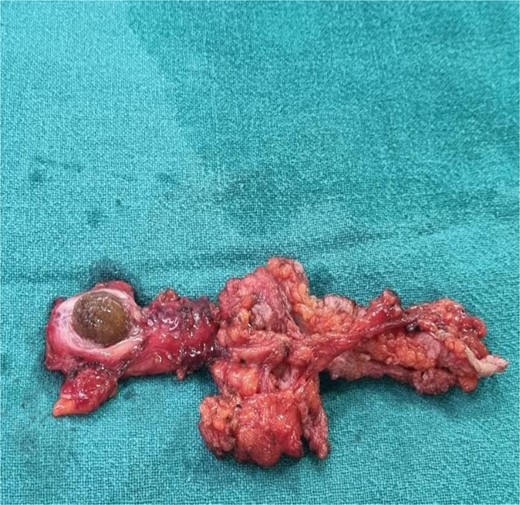 Intraoperative image showing cystocutaneous fistula tract with stone in remnant gall bladder