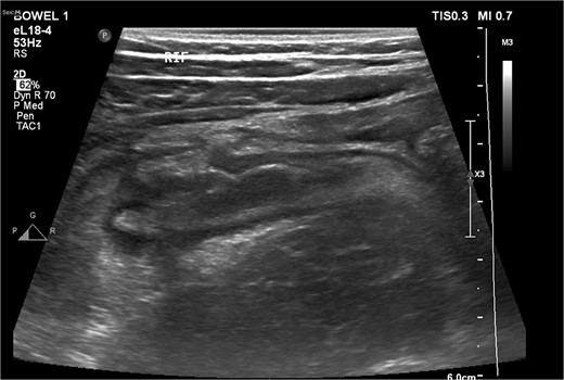 An ultrasound picture showing tubular-like structure surrounded by edematous fluid.