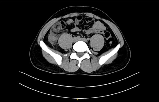 CT scan picture with an axial view showing acute inflamed appendix with peri-appendicular fat smudging, confirming the radiological finding of acute appendicitis.
