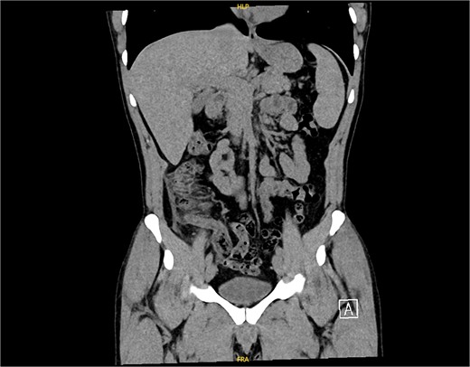 CT scan picture with a coronal view showing acute inflamed appendix with peri-appendicular fat smudging, confirming the radiological finding of acute appendicitis.