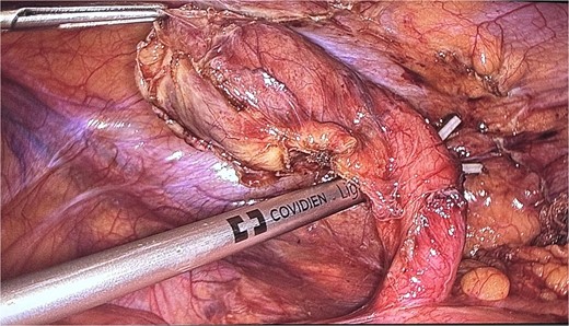 An intraoperative picture of an acutely inflamed appendix with mass seen at the tip; the mass was manipulated carefully and grasped at peri-appendicular tissue to avoid mass rupture.