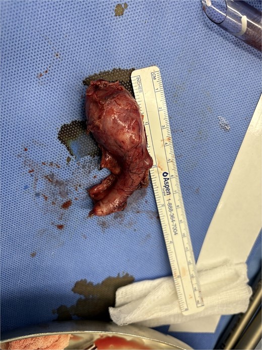 A gross picture of the appendix with mass noticed at the tip and multiple nodules over the appendicular surface.