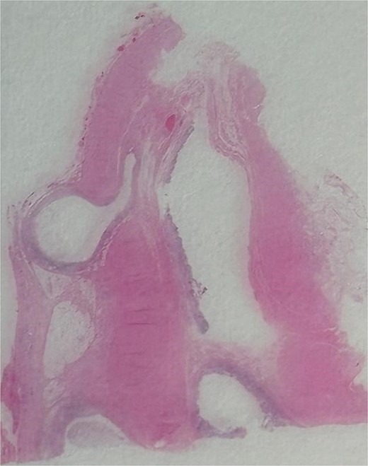 An image showing a whole-slide longitudinal section of the distal appendix demonstrating multiple outpouchings of mucosa through weak points of the muscular wall.