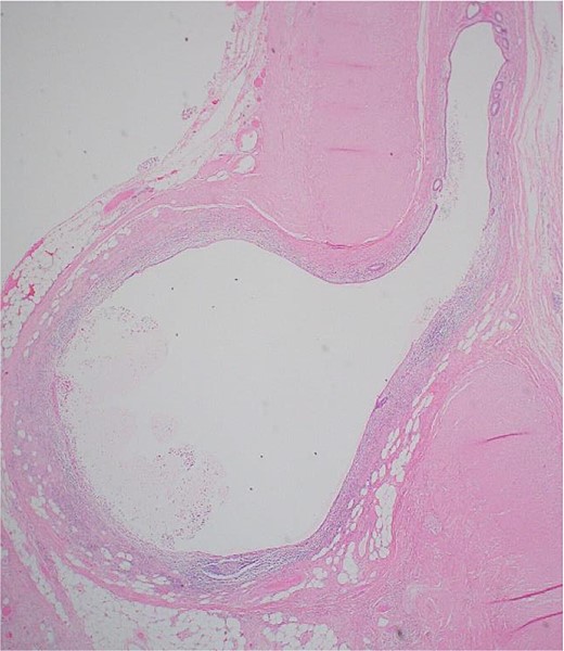 An image demonstrating one diverticulum at ocular power ×2.